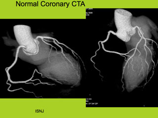 Normal Coronary CTA