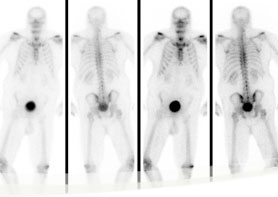Nuclear Bone Scan